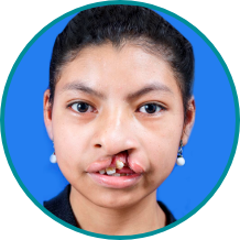 tratamiento-labio-y-paladar-hendido-Gema-Antes